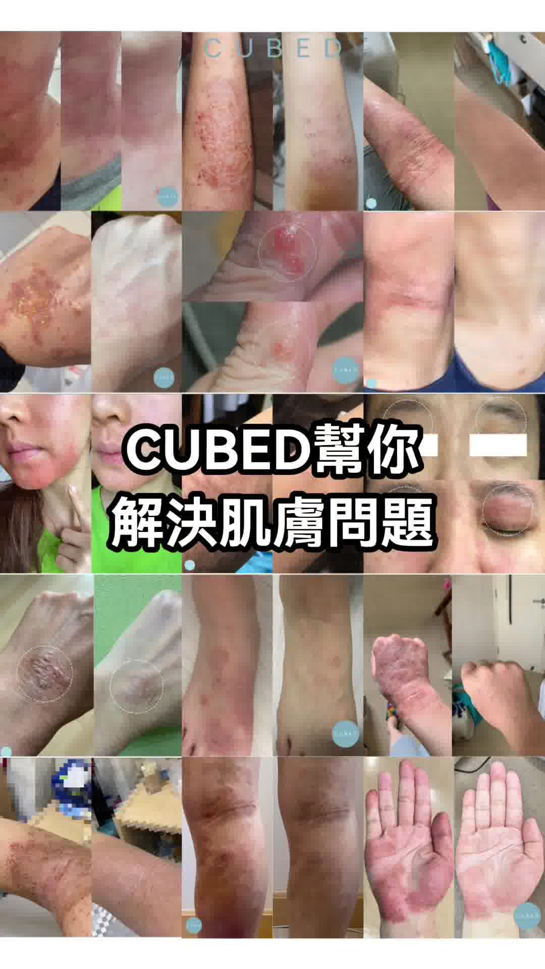 擊敗濕疹，奪回肌膚自由
