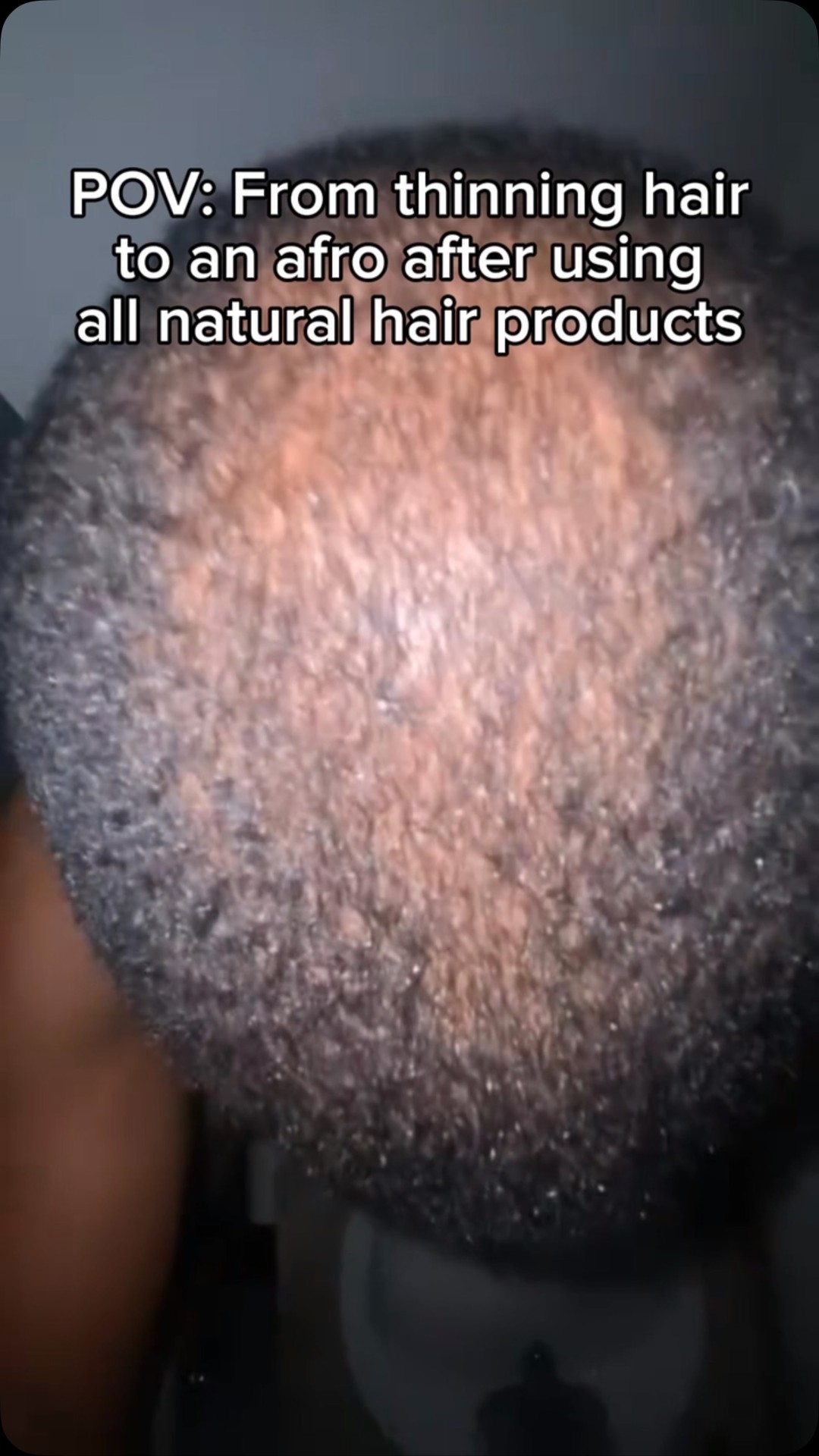 Once you reduce the inflammation and fungus on the scalp your hair will grow like God intended 🔑

Your scalp will thank you after going all natural 🌿

Click link in bio✅