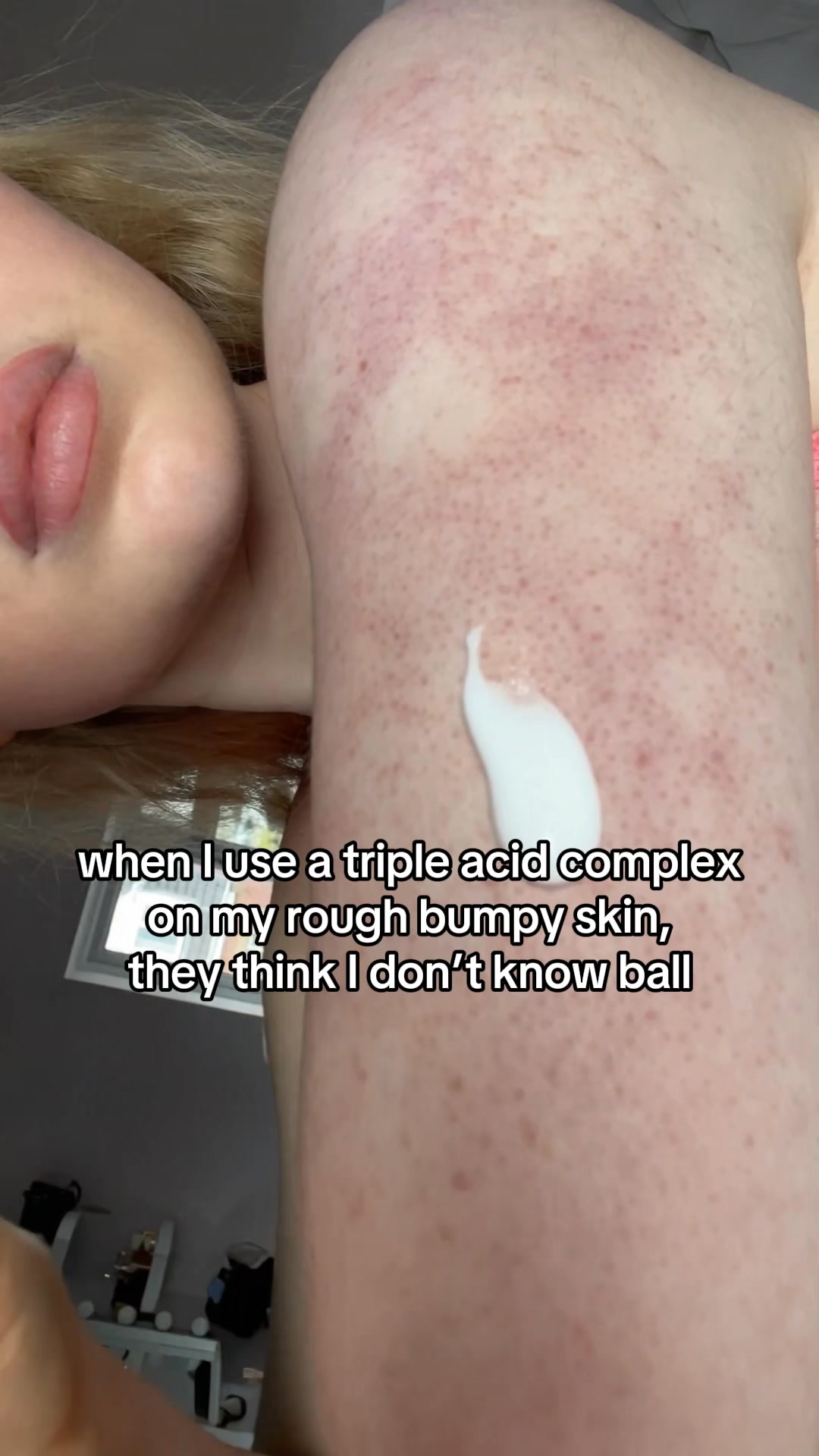 Triple-Acid Complex for KP