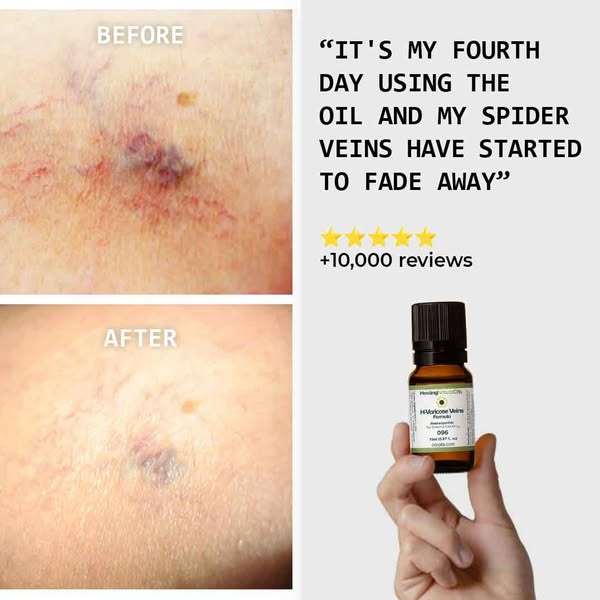 The Natural Choice For Varicose Veins